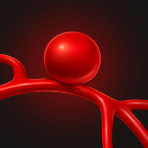 A brain aneurysm is a bulging area in an artery in the brain, similar to a thin balloon. It becomes life-threatening if it ruptures.