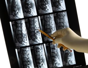 An MRI shows the spinal structure of the lower back. The difference between a discogram and an MRI is that a discogram can confirm that cause of back pain.
