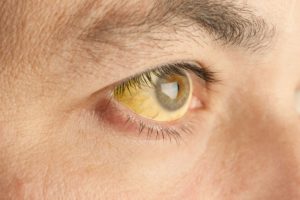 Symptoms of cirrhosis include yellowing of the eyes, known as jaundice.